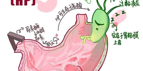 【必看】幽門螺桿菌真相揭示，別再忽視你的胃痛了！