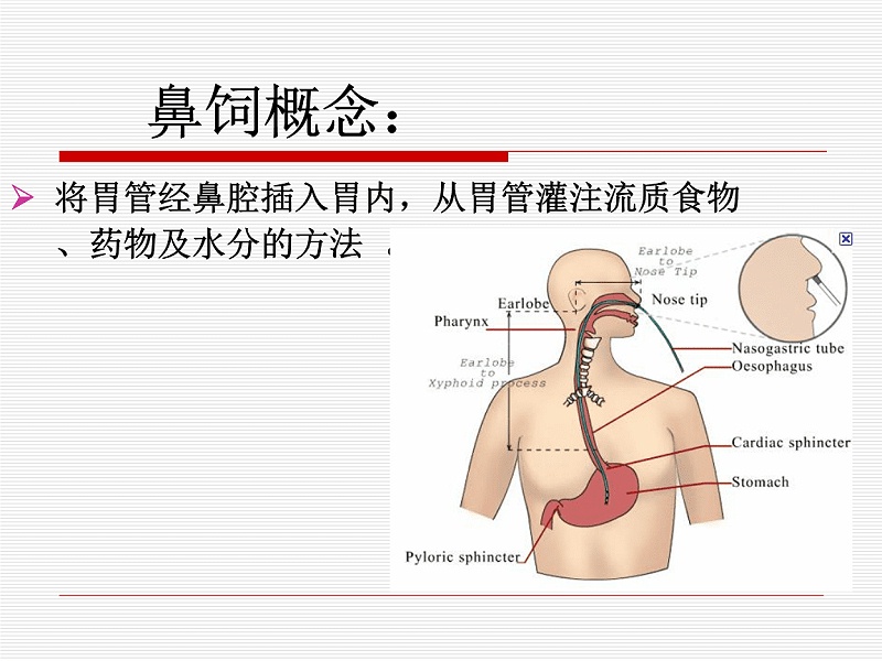 如何給昏迷患者使用注射器鼻飼