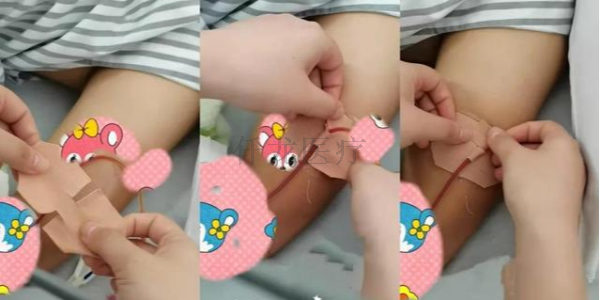 巧用3M宜拉膠帶制作導(dǎo)管固定貼