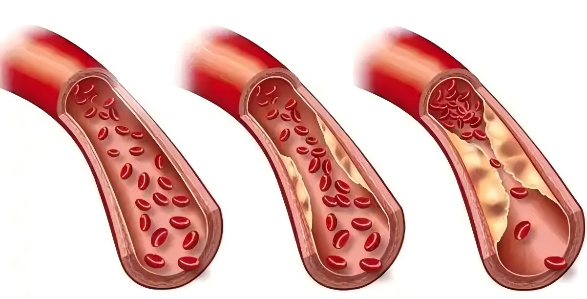 頭暈、視力模糊？小心高血脂在偷偷傷害你！